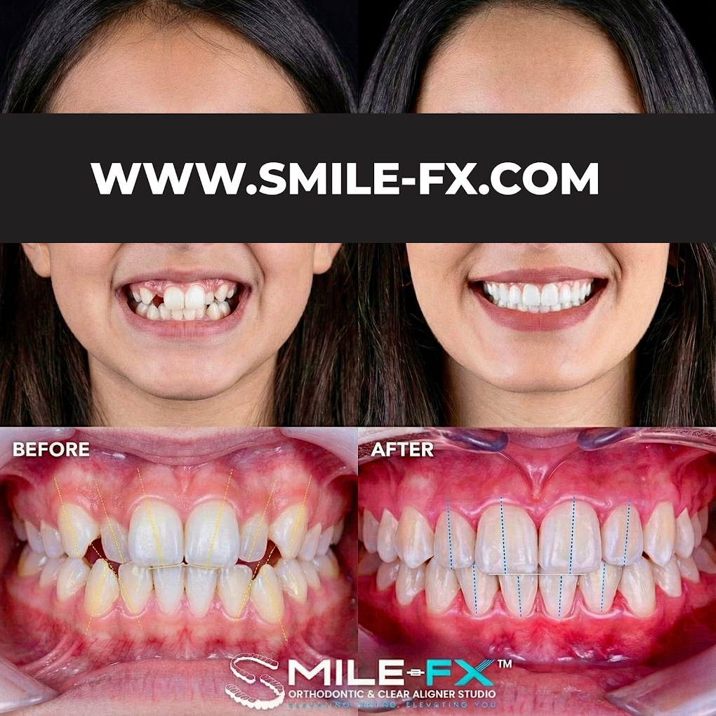 Before and after orthodontic smile transformation showing dramatic improvement